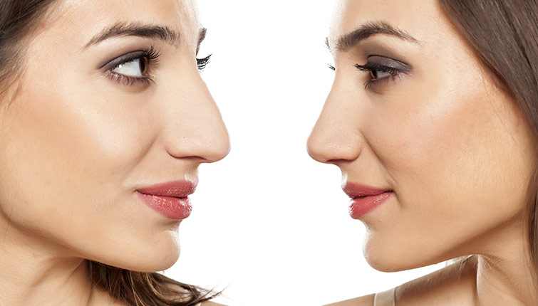 rhinoplastie-chirurgie-correction-nez